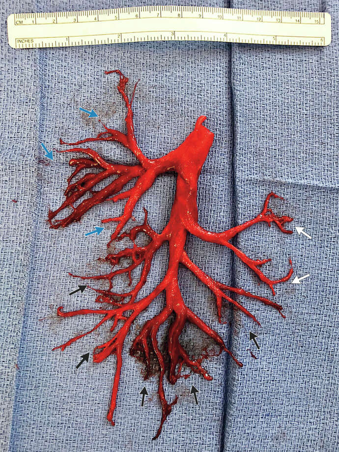 patient"s "extreme" coughing fit forces out blood clot in the