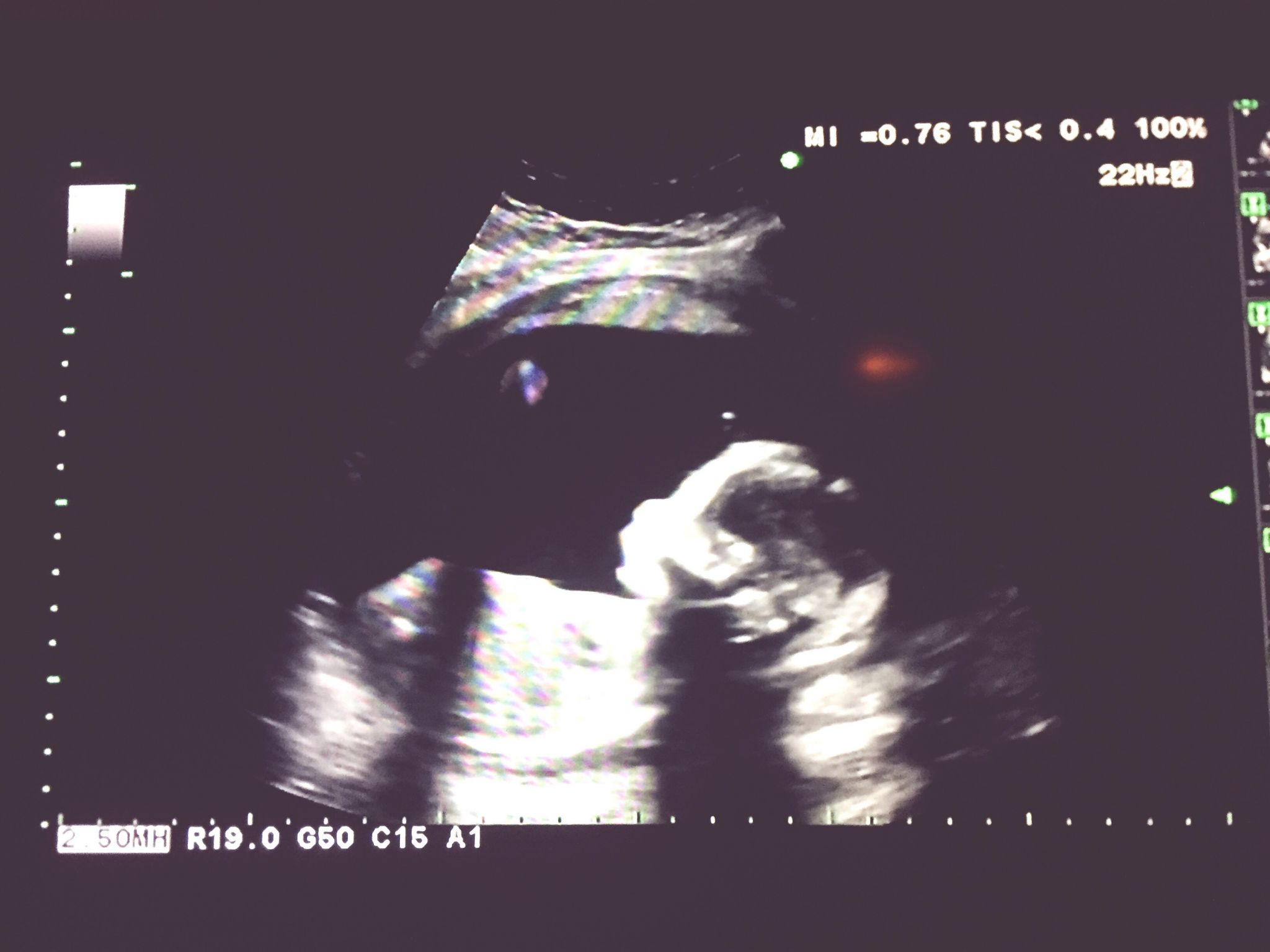 UW Study No amount of alcohol is safe for pregnant women due to