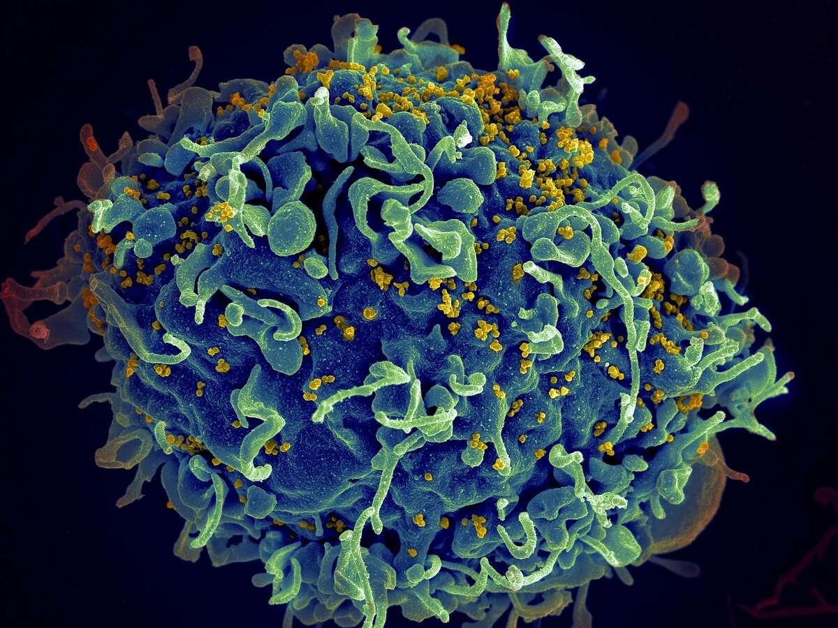 In an undated photo from the National Institutes of Health, a human T cell (blue) is under attack by HIV (yellow), the virus that causes AIDS. The virus specifically targets T cells, which play a critical role in the body's immune response against invaders like bacteria and viruses. For just the second time since the global epidemic began, a patient appears to have been cured of infection with HIV, according to investigators who published their report on March 5, 2019. (National Institutes of Health/The New York Times) EDITORIAL USE ONLY