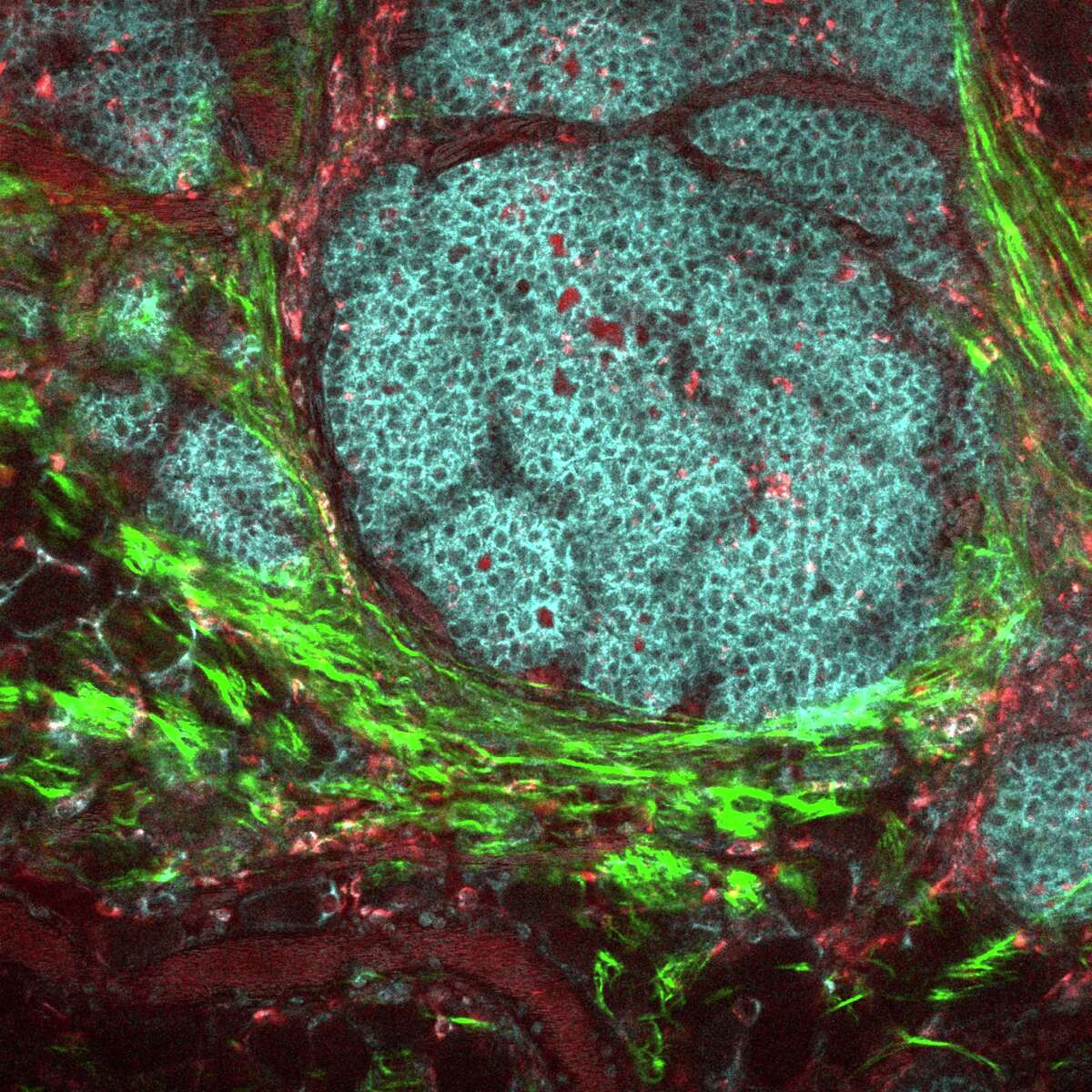 An image of a breast cancer tumor and its microenvironment. Tumor cells are in cyan, macrophages in red and collagen fibers in green.