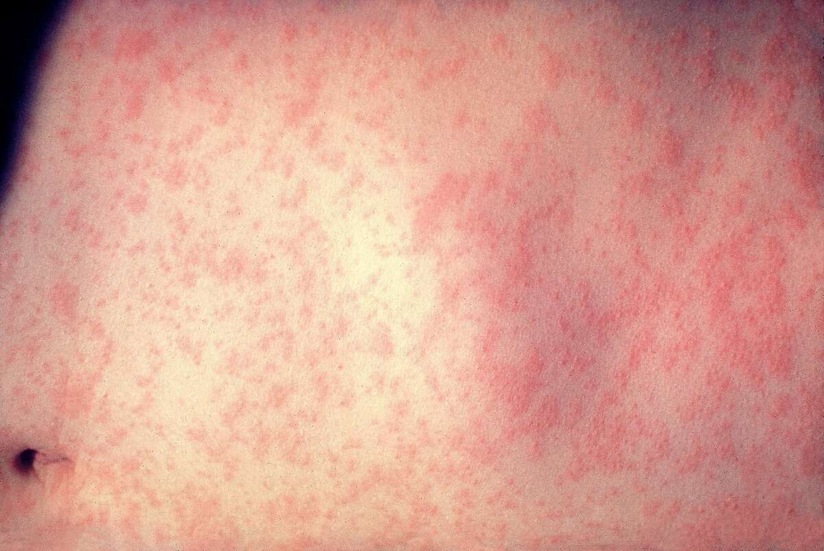 This photograph reveals the skin rash on a patient’s abdomen three days after the onset of a measles infection. The image was captured at New York Hospital-Cornell Medical Center.