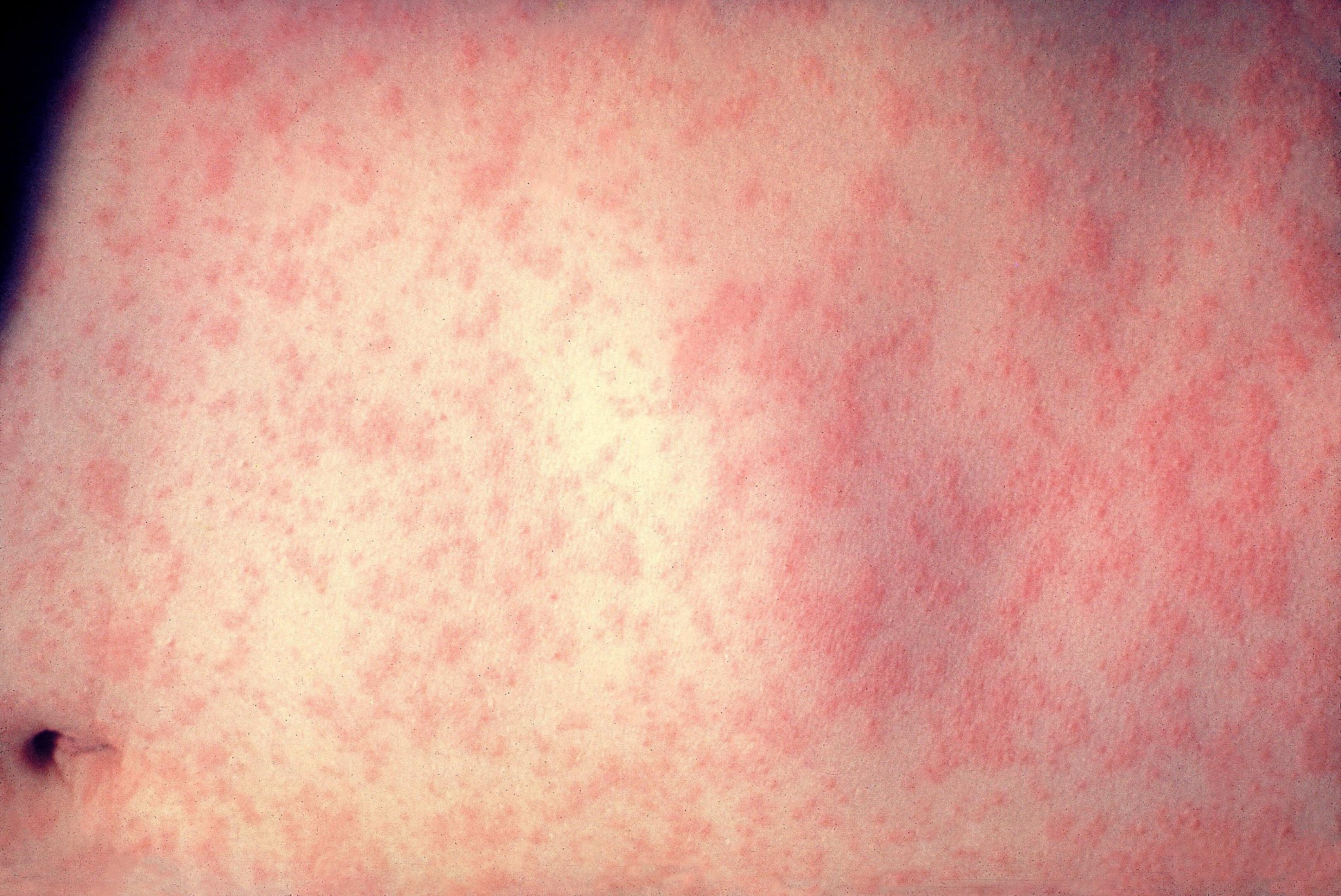 How can those vaccinated still get measles? Although effective, it's no  sure thing – Orange County Register