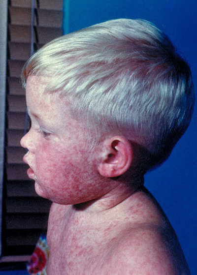 Photos reveal what it looks like to get the measles when there are no vaccines