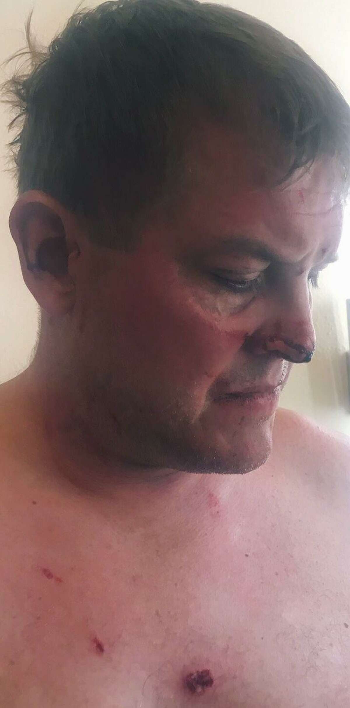Gavin Scott Hapgood’s family released a photo showing bite marks to his face and chest they say occurred during a struggle with a hotel worker in Anguilla.