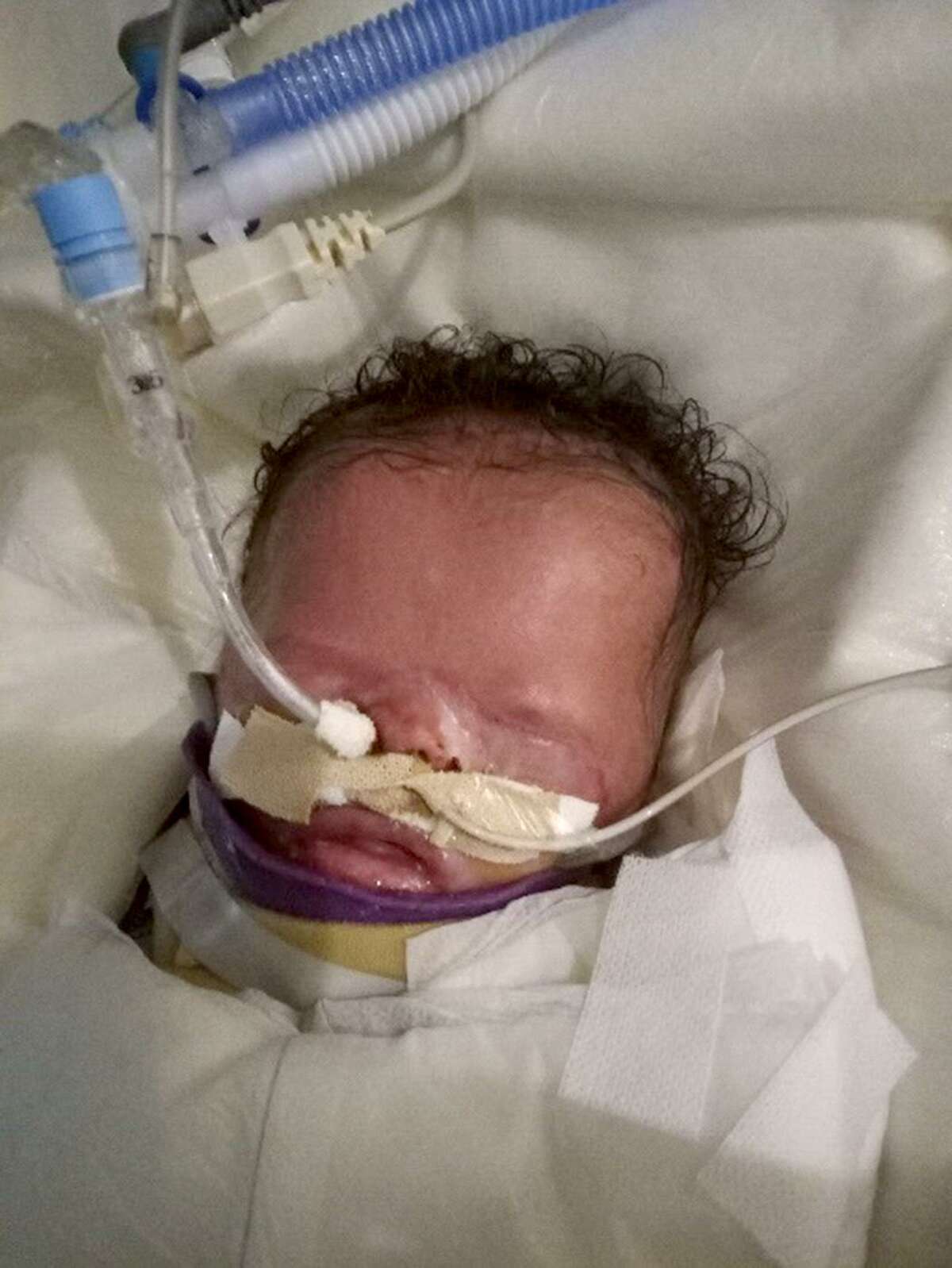 San Antonio baby born without skin receives labgrown skin grafts