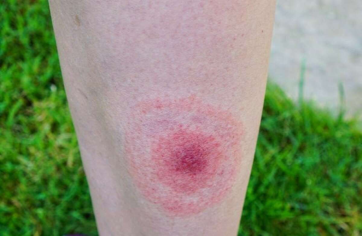 Researchers are inviting New Yorkers who develop a circular rash following a tick bite this summer to consider donating their blood. The above rash is an example of what to watch for.