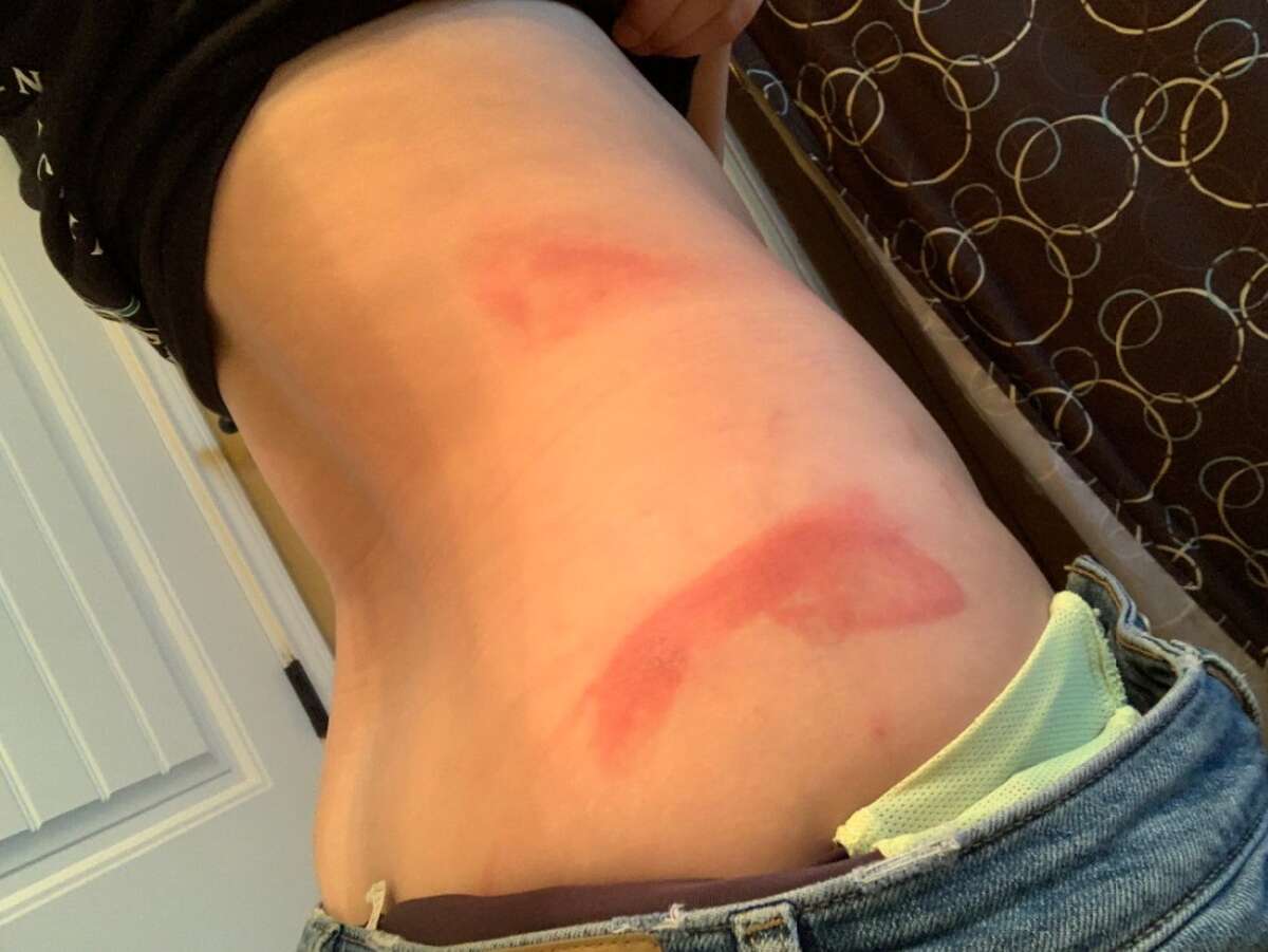 Sydney Potts, 19, took pictures of the rash she obtained after swimming in the San Gabriel River in Williamson County.