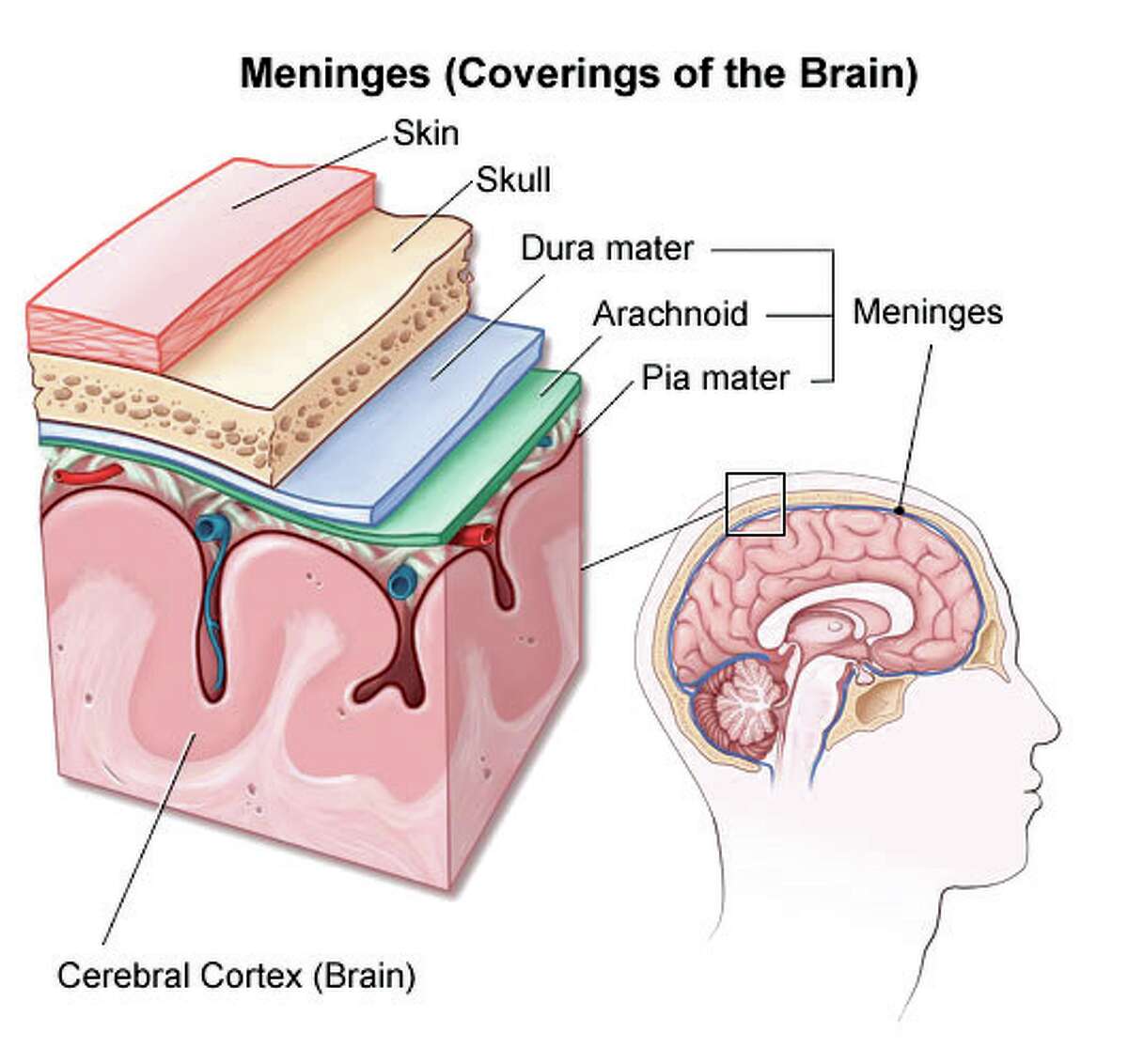 Bacterial Meningitis Symptoms And Risk Factors Of This Quiet Killer