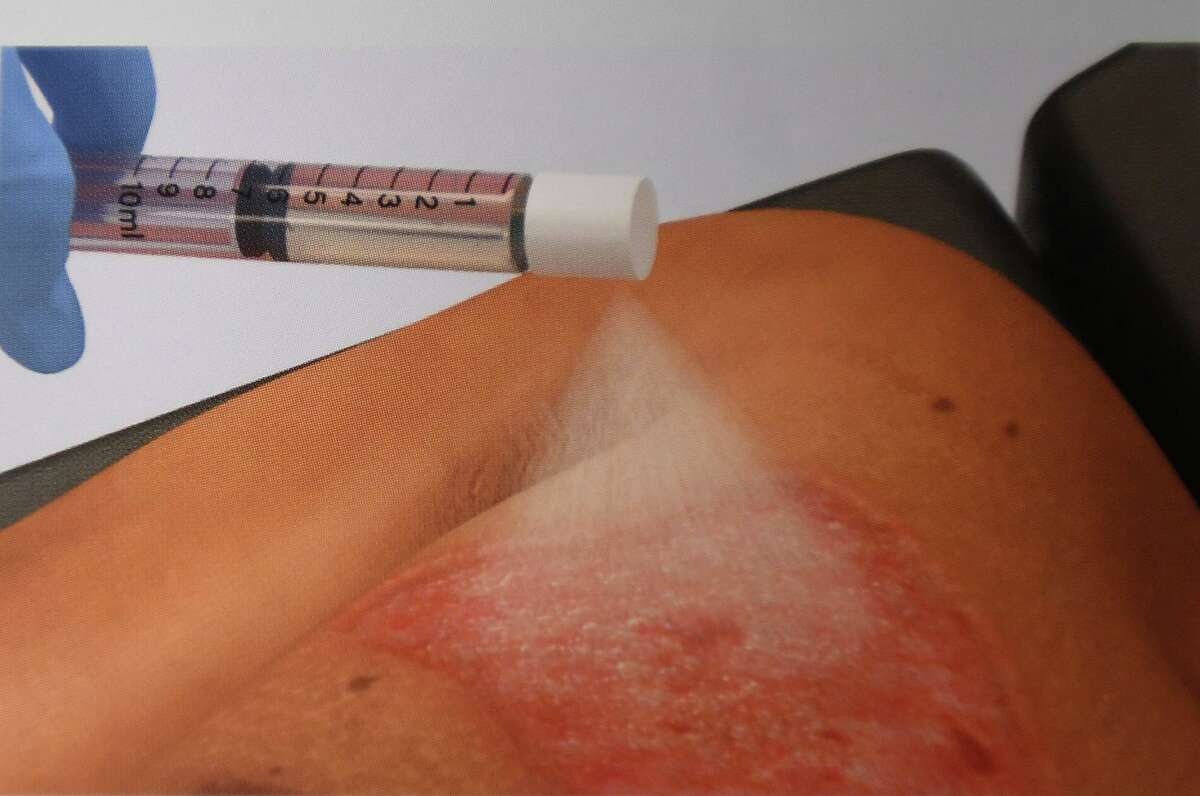 RECELL, a system that creates spray on skin from a patient's own cells for use in burn treatment, is now in use at the Connecticut Burn Center at Bridgeport Hospital in Bridgeport, Conn. on Wednesday, July 24, 2019.