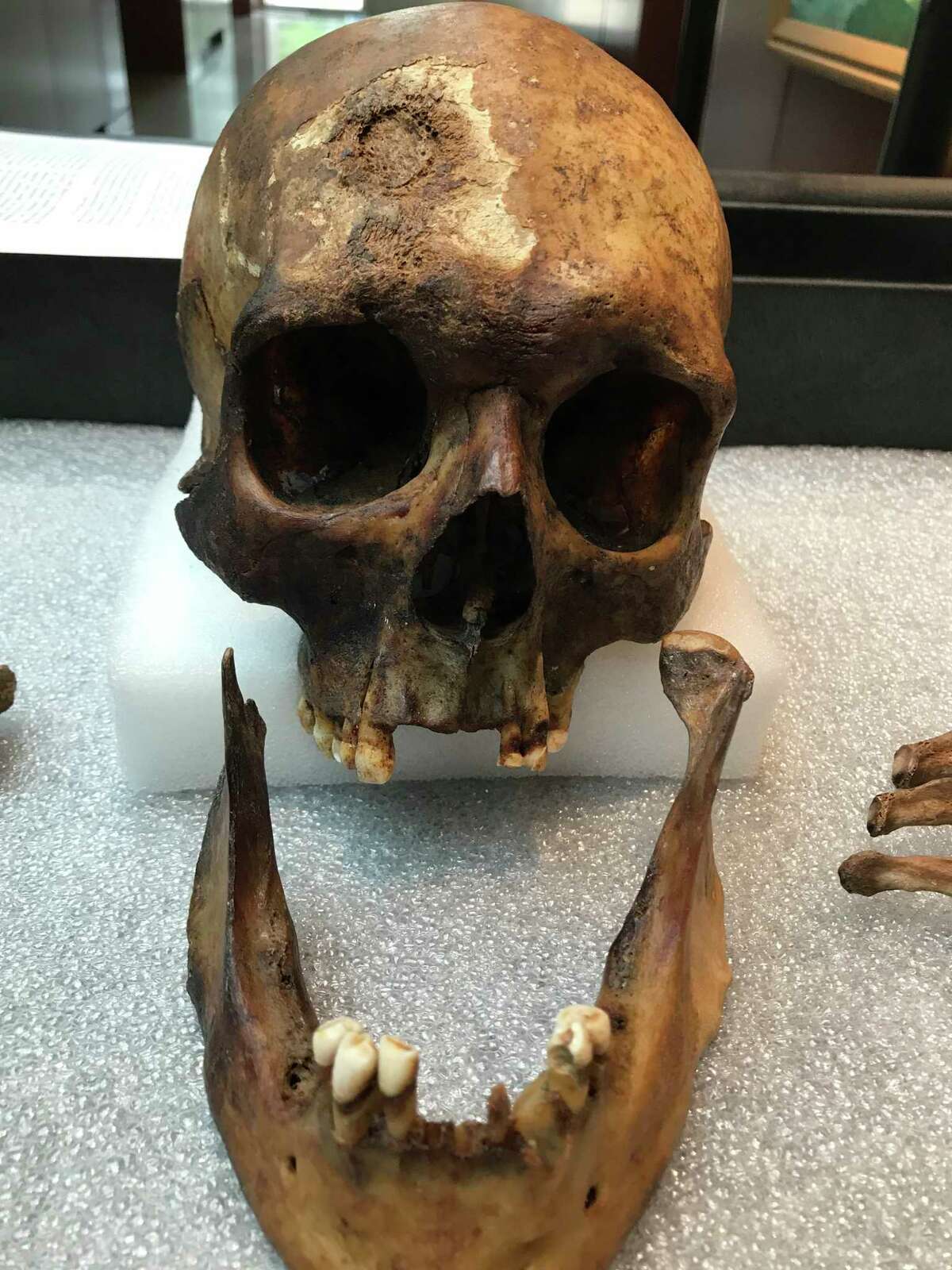 The skull of the man believed to be John Barber at the National Museum of Health and Medicine in Silver Spring, Maryland, on July 23, 2019.