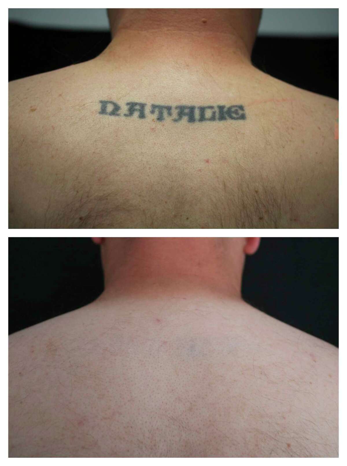 Best Tattoo Removal Method Expert Dermatologist ClearSkin
