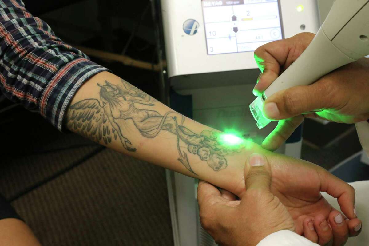 Details 72 tattoo removal los angeles latest  thtantai2