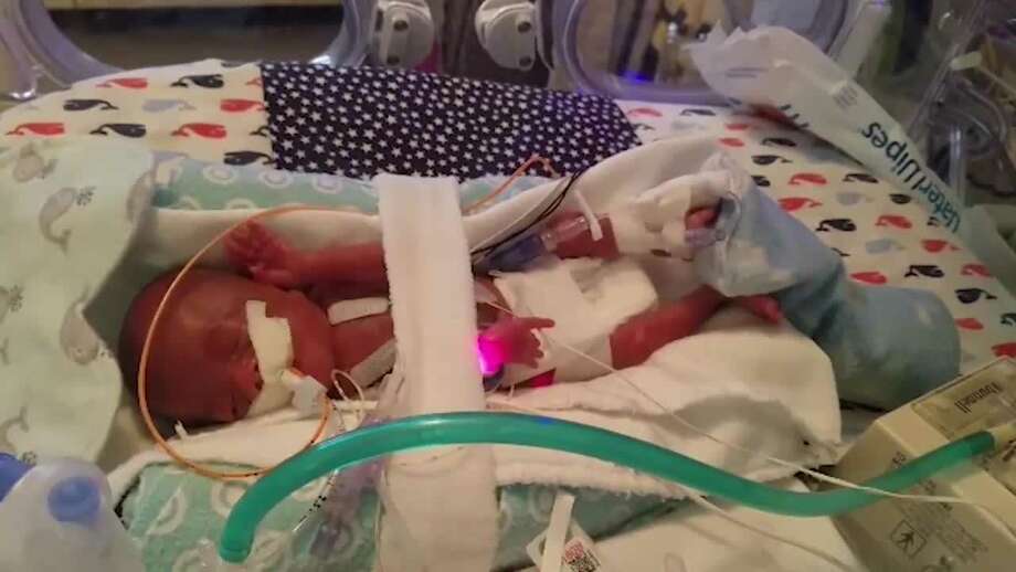 Family confirms death of miracle baby born weighing 13 oz. Alton