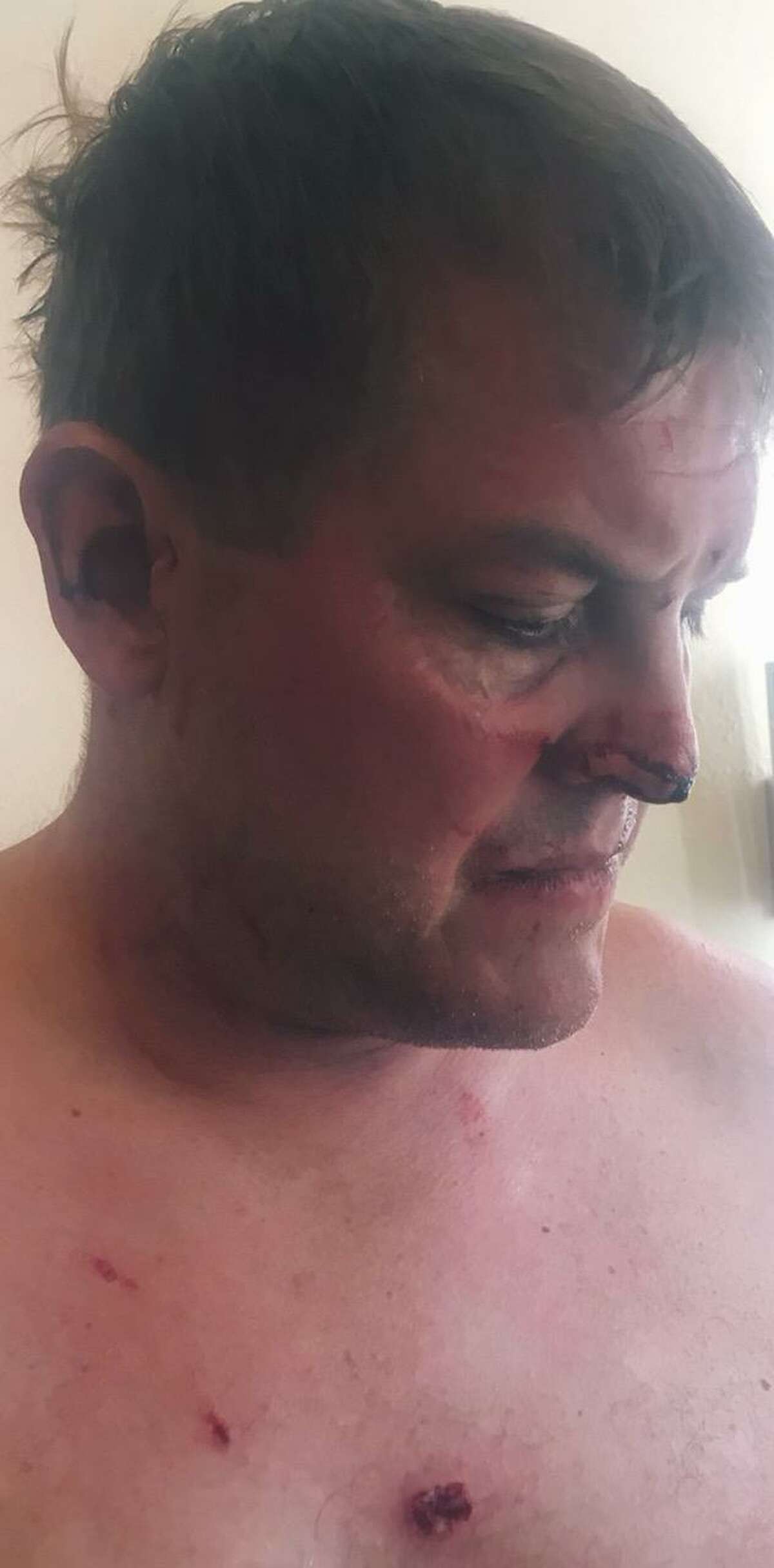 Gavin Scott Hapgood suffered bruises and bite marks in the struggle with hotel worker Kenny Mitchel, according to Hapgood’s family.