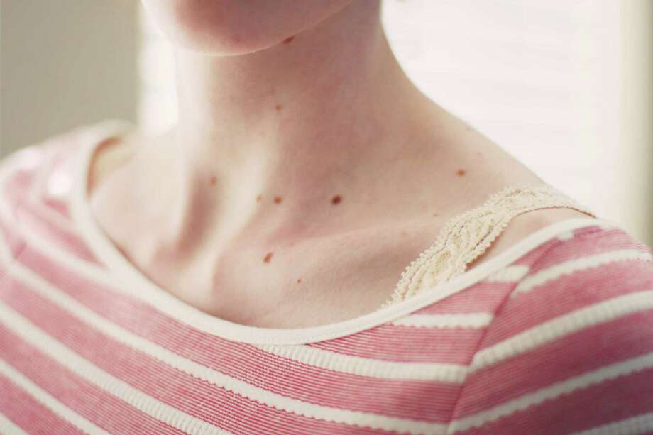 13 Photos Of Skin Spots And What Caused Them Alton Telegraph