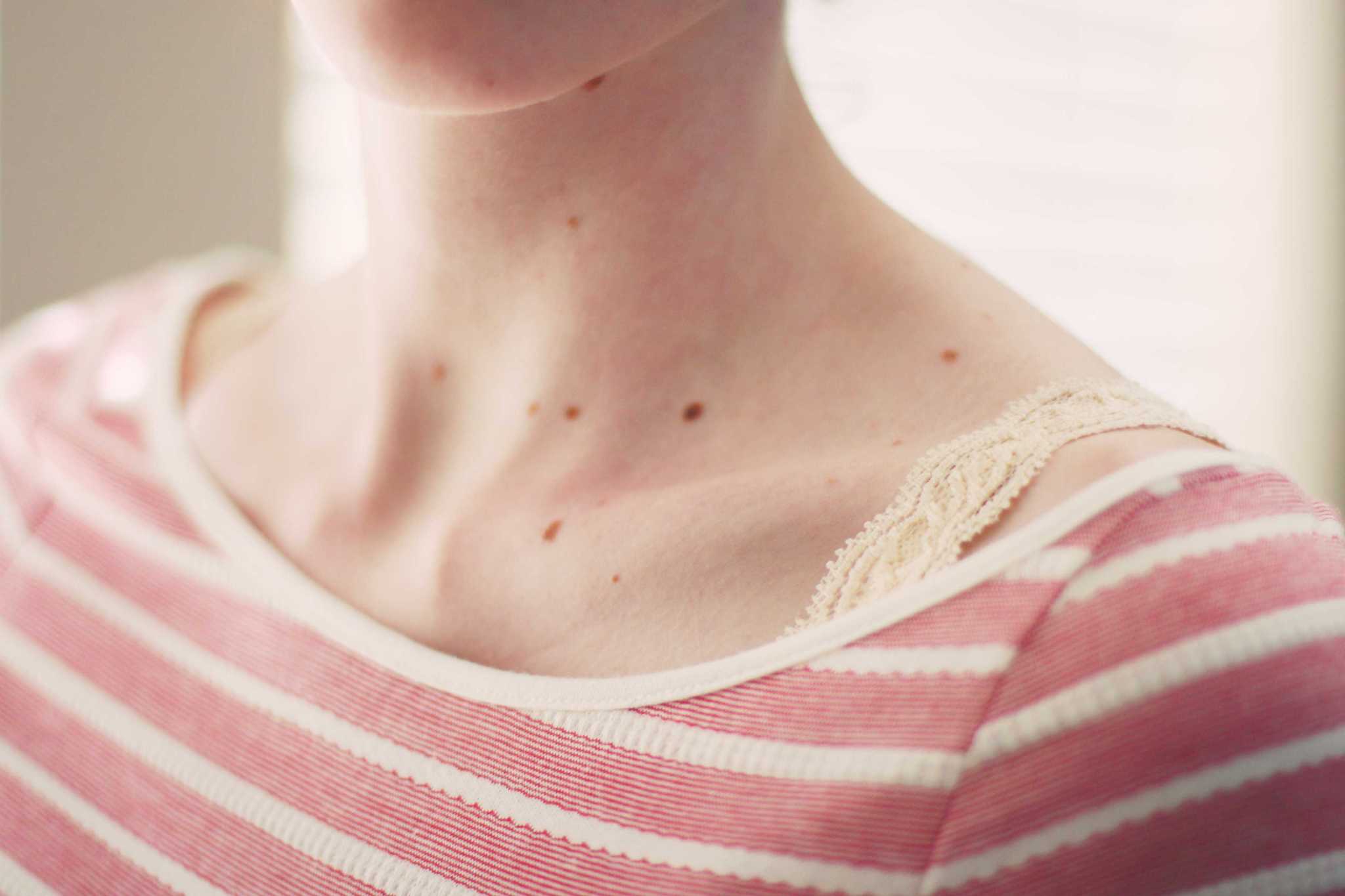 13-photos-of-skin-spots-and-what-caused-them