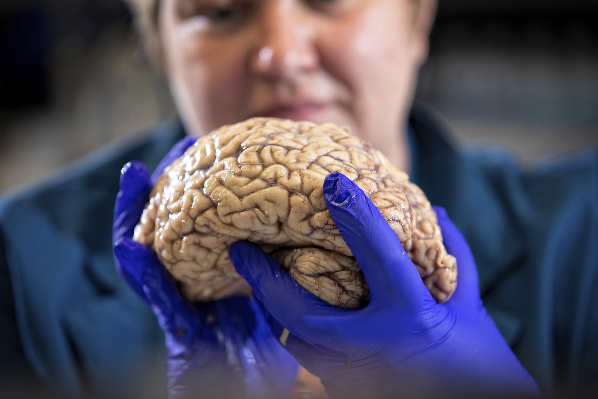 Scientists rethink Alzheimer’s, diversifying approach