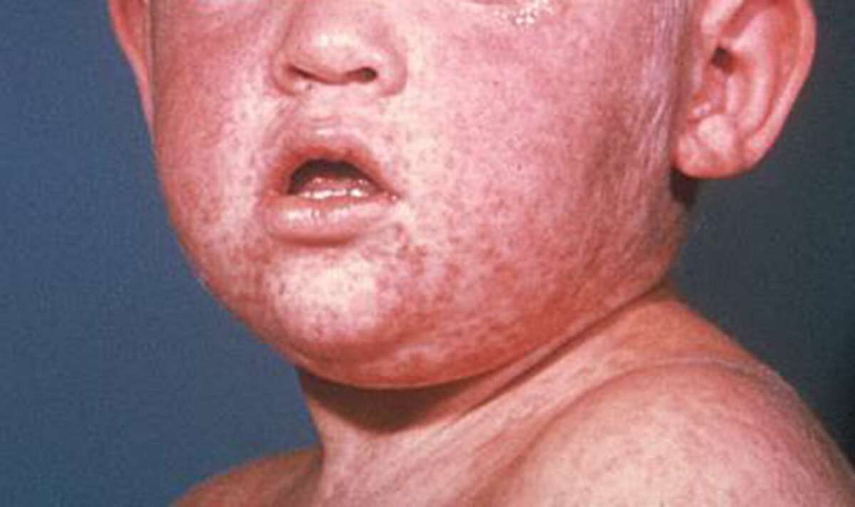 The face of a boy after three days with a measles rash.(Centers for Disease Control and Prevention/TNS
