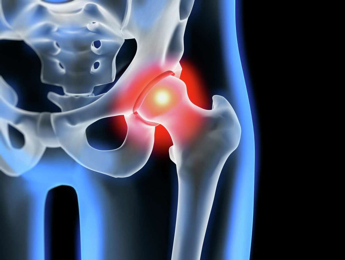Griffin Hospital offers free presentation on minimally invasive hip surgery Oct. 16