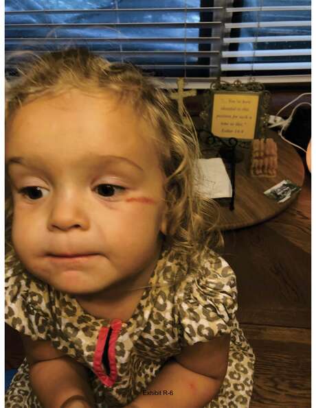 Charlotte had a gash on her face after she returned from foster care. Courtesy photo