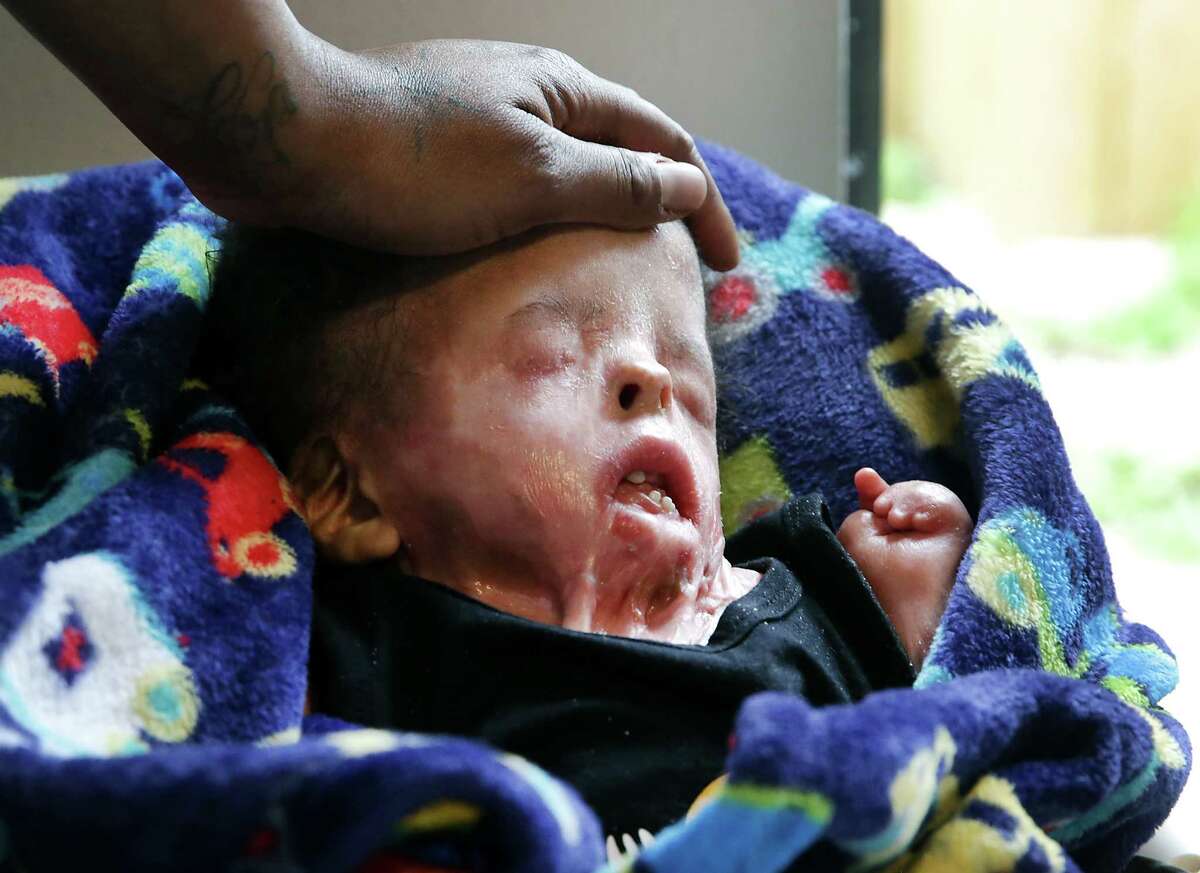 Ja'bari Gray, born without skin on most of his body on Jan. 1, 2019 celebrated his first birthday on Wednesday, Jan. 1, 2020. Marvin Gray, his father, touches his son’s head.
