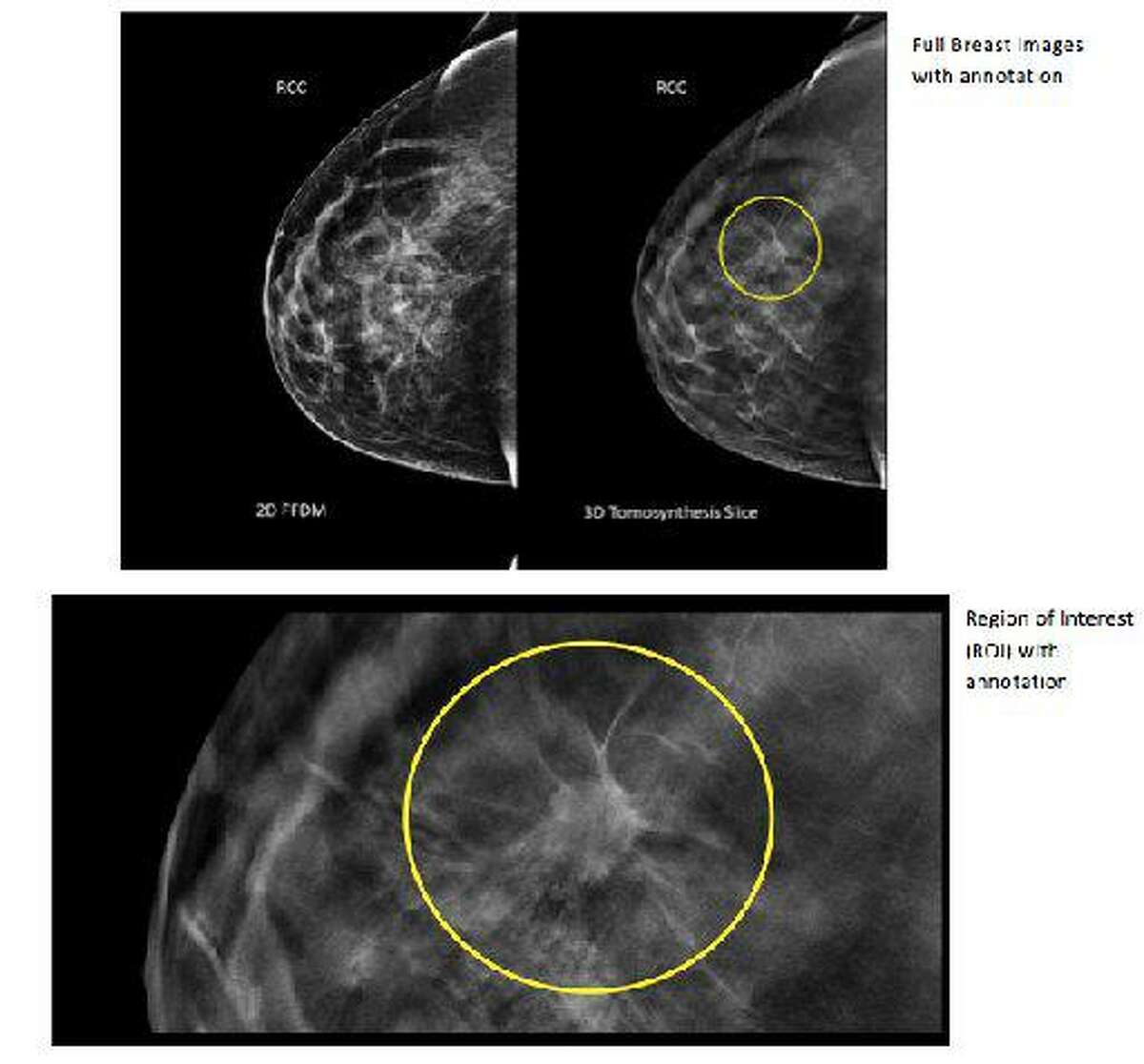 Контрастная спектральная маммография