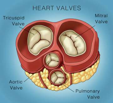 Mitral valve repair: minimally invasive heart surgery vs. sternotomy ...