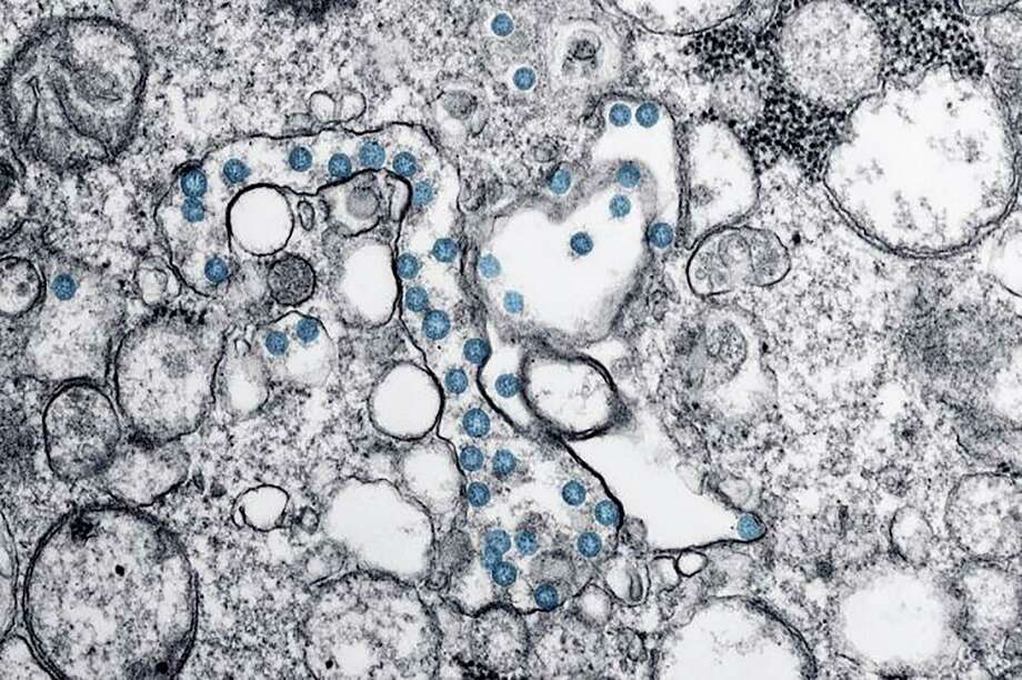 This handout illustration image obtained February 27, 2020 courtesy of the Centers for Disease Control and Prevention (CDC) shows a transmission electron microscopic image of an isolate from the first US case of COVID-19, formerly known as 2019-nCoV, with the spherical viral particles, colorized blue, containing cross-sections through the viral genome, seen as black dots. - President Donald Trump has played down fears of a major coronavirus outbreak in the United States, even as infections ricochet around the world, prompting a ban on pilgrims to Saudi Arabia. China is no longer the only breeding ground for the deadly virus as countries fret over possible contagion coming from other hotbeds of infection, including Iran, South Korea and Italy. There are now more daily cases being recorded outside China than inside the country, where the virus first emerged in December, according to the World Health Organization. (Photo by HANDOUT/Centers for Disease Control and /AFP via Getty Images) Photo: HANDOUT / Centers For Disease Control And /AFP Via Getty Images / AFP or licensors