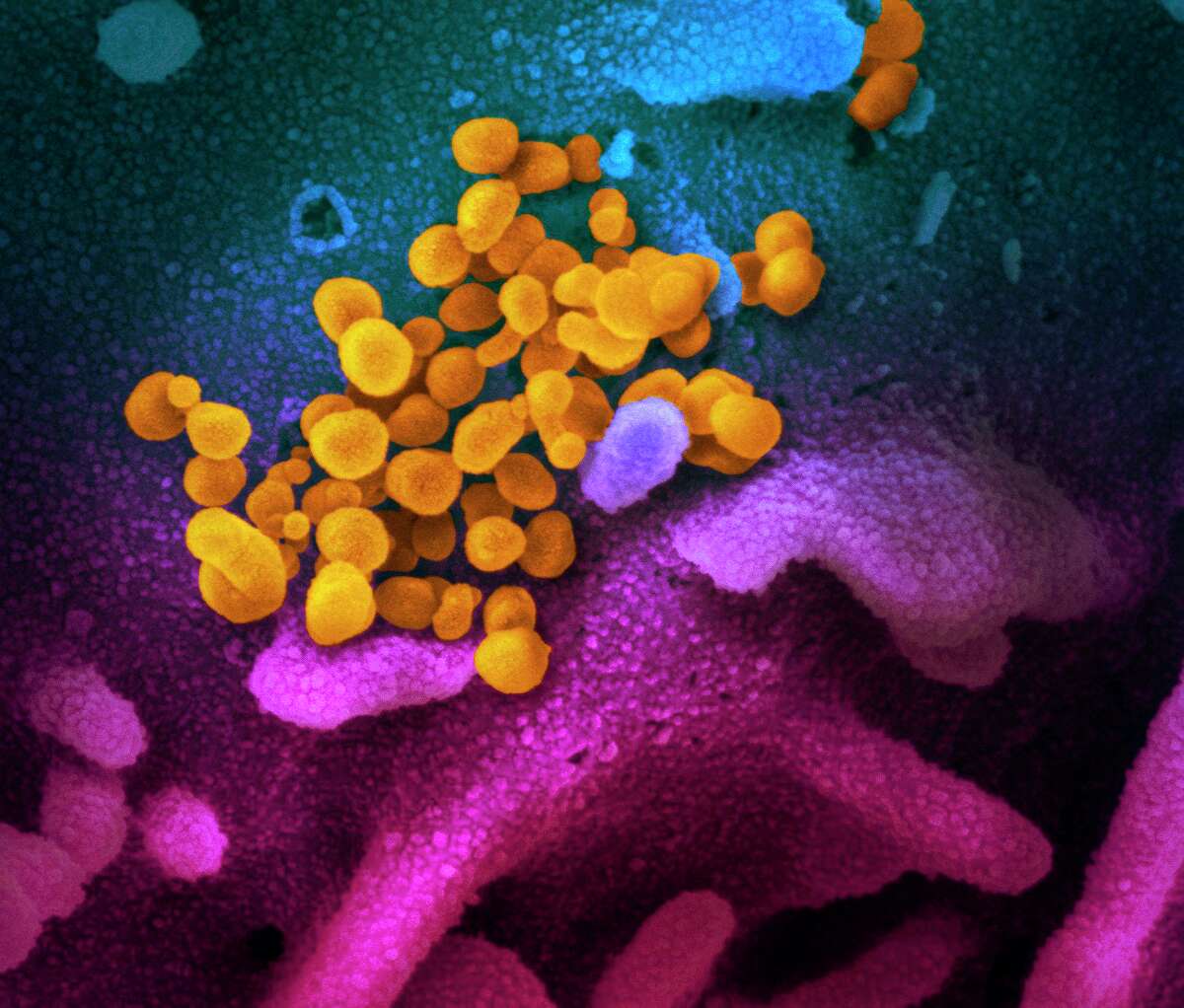 This file photo handout illustration image obtained recently courtesy of the National Institutes of Health taken with a scanning electron microscope shows SARS-CoV-2 (yellow)also known as 2019-nCoV, the virus that causes the disease COVID-19 isolated from a patient in the U.S., emerging from the surface of cells (blue/pink) cultured in the lab. Faulty test kits for the novel coronavirus coupled with a diagnostic strategy that initially targeted too few people allowed the disease to spread beyond U.S. authorities' ability to detect it, health experts have said. Writing in the Journal of the American Medical Association (JAMA) recently, epidemiologists from Johns Hopkins University and Stanford University said the failings had contributed to the virus taking root in communities across the country. Connecticut state Representative, Lucy Dathan, whose district represents parts of New Canaan has just the information about COVID-19, that residents of the town may need to deal with its crisis.