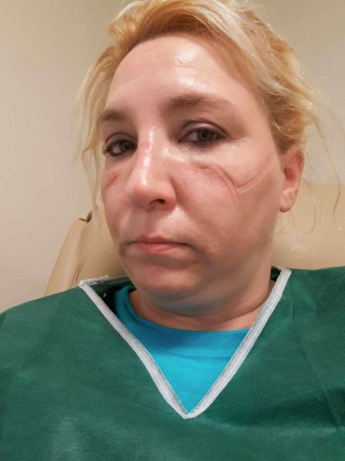 Joy Kohlhoff is pictured with imprints from personal protection equipment on her face after a long hospital shift. (Photo provided)