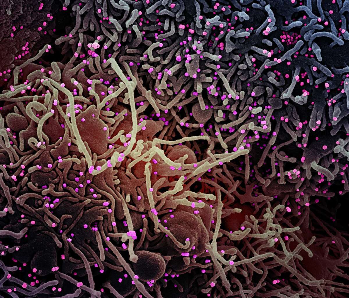 Colorized scanning electron micrograph of a cell after infection with SARS-COV-2 virus particles, which were isolated from a patient sample. Image captured at the NIAID Integrated Research Facility in Fort Detrick, Maryland.