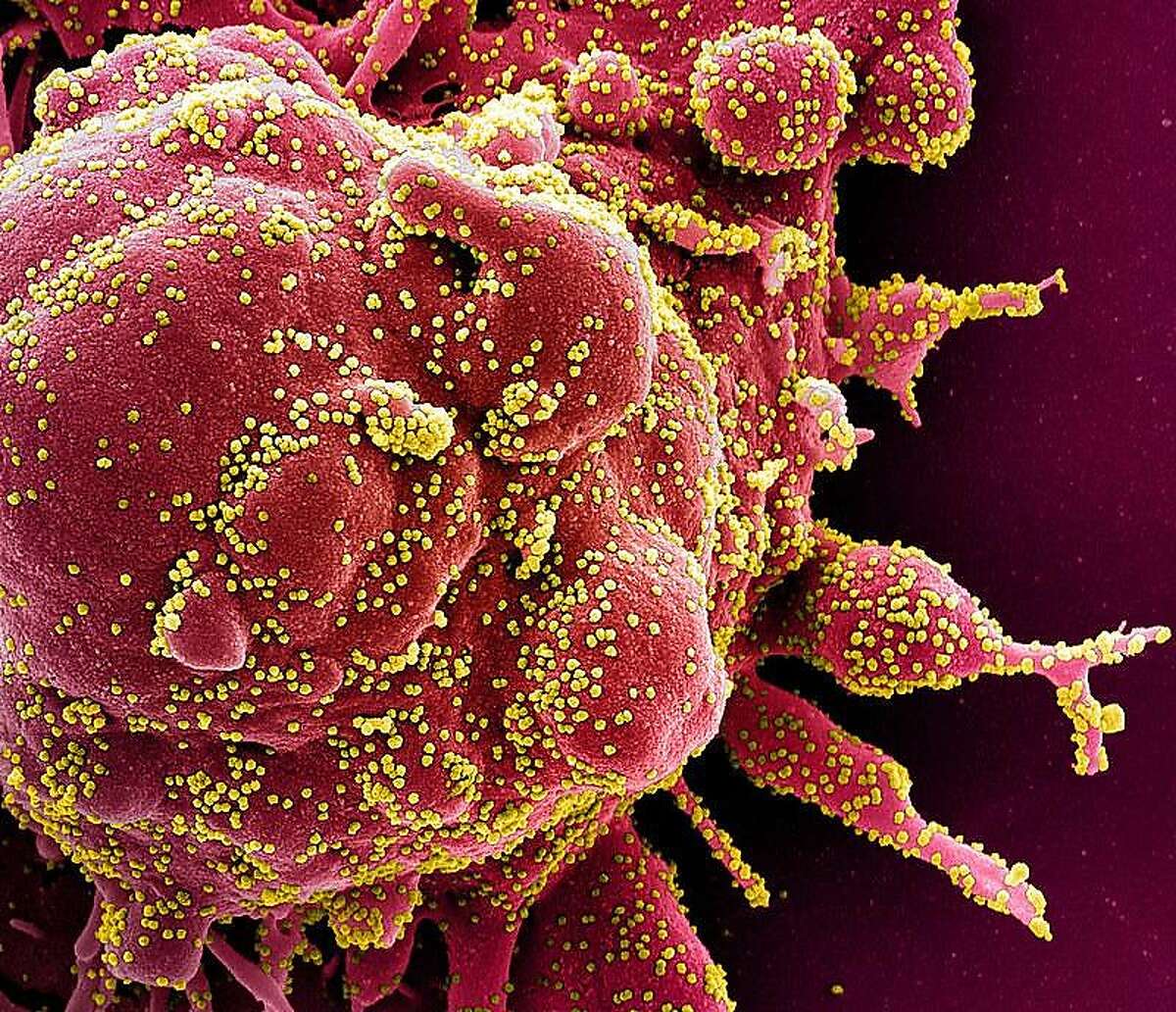 This handout image obtained on April 29, 2020 and released by the National Institute of Allergy and Infectious Diseases (NIAID) of the National Institutes of Health (NIH), shows a colorized scanning electron micrograph of an apoptotic cell (red) heavily infected with SARS-COV-2 virus particles (yellow), isolated from a patient sample captured at the NIAID Integrated Research Facility (IRF) in Fort Detrick, Maryland. - The US intelligence community said Thursday it had concluded that the novel coronavirus that has swept the globe originated in China but was not man-made or engineered. (Photo by Handout / National Institute of Allergy and Infectious Diseases / AFP) / RESTRICTED TO EDITORIAL USE - MANDATORY CREDIT "AFP PHOTO / NATIONAL INSTITUTE OF ALLERGY AND INFECTIOUS DISEASES, NIH " - NO MARKETING - NO ADVERTISING CAMPAIGNS - DISTRIBUTED AS A SERVICE TO CLIENTS (Photo by HANDOUT/National Institute of Allergy an/AFP via Getty Images)