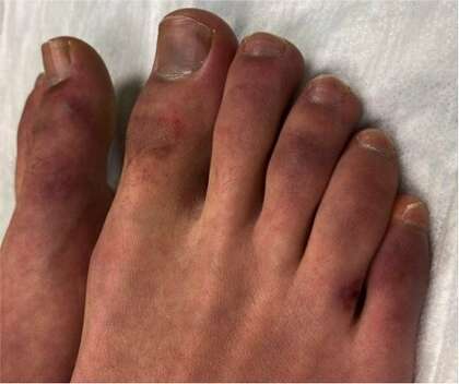 Ucsf Doctor Sees Mysterious Swelling Of Feet In Children Possibly