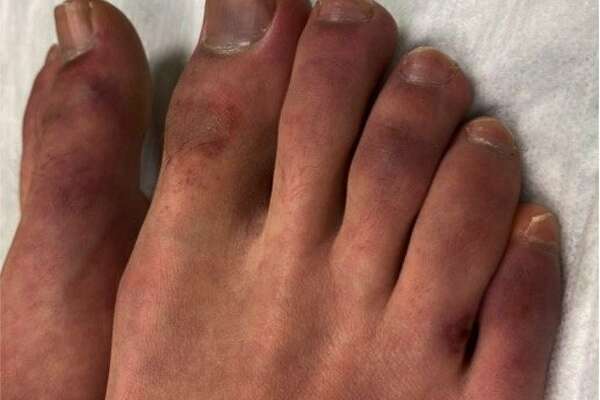 Ucsf Doctor Sees Mysterious Swelling Of Feet In Children Possibly Coronavirus Related Sfchronicle Com
