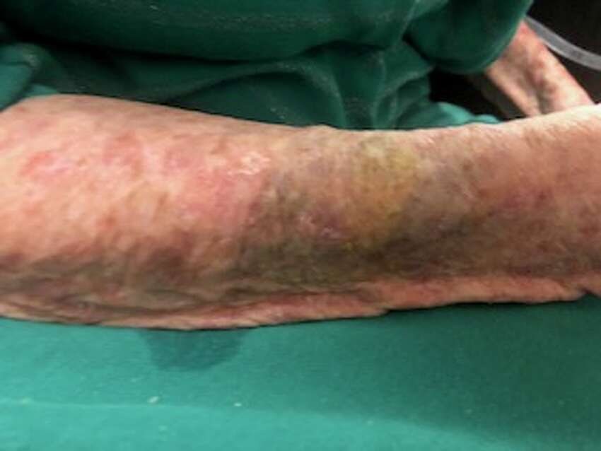 Mary Beth Delarm began documenting visits to her mother at the Diamond Hill nursing home in Schaghticoke last year. She believes her mother, who is in her 90s and has dementia, was being neglected based on the conditions she often found her in. In this photo is a bruise that staff couldn't explain.