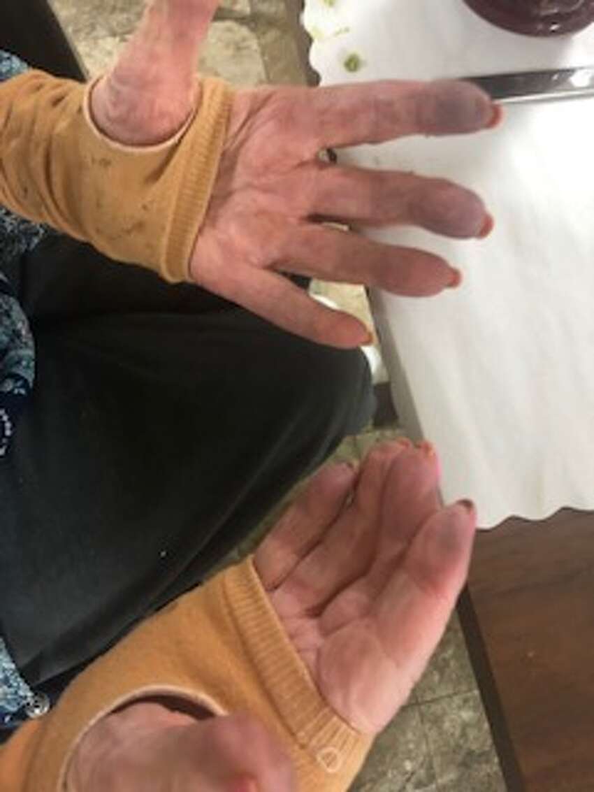 Mary Beth Delarm began documenting visits to her mother at the Diamond Hill nursing home in Schaghticoke last year. She believes her mother, who is in her 90s and has dementia, was being neglected based on the conditions she often found her in. In this photo, her mothers fingers are dirty and turning purple.