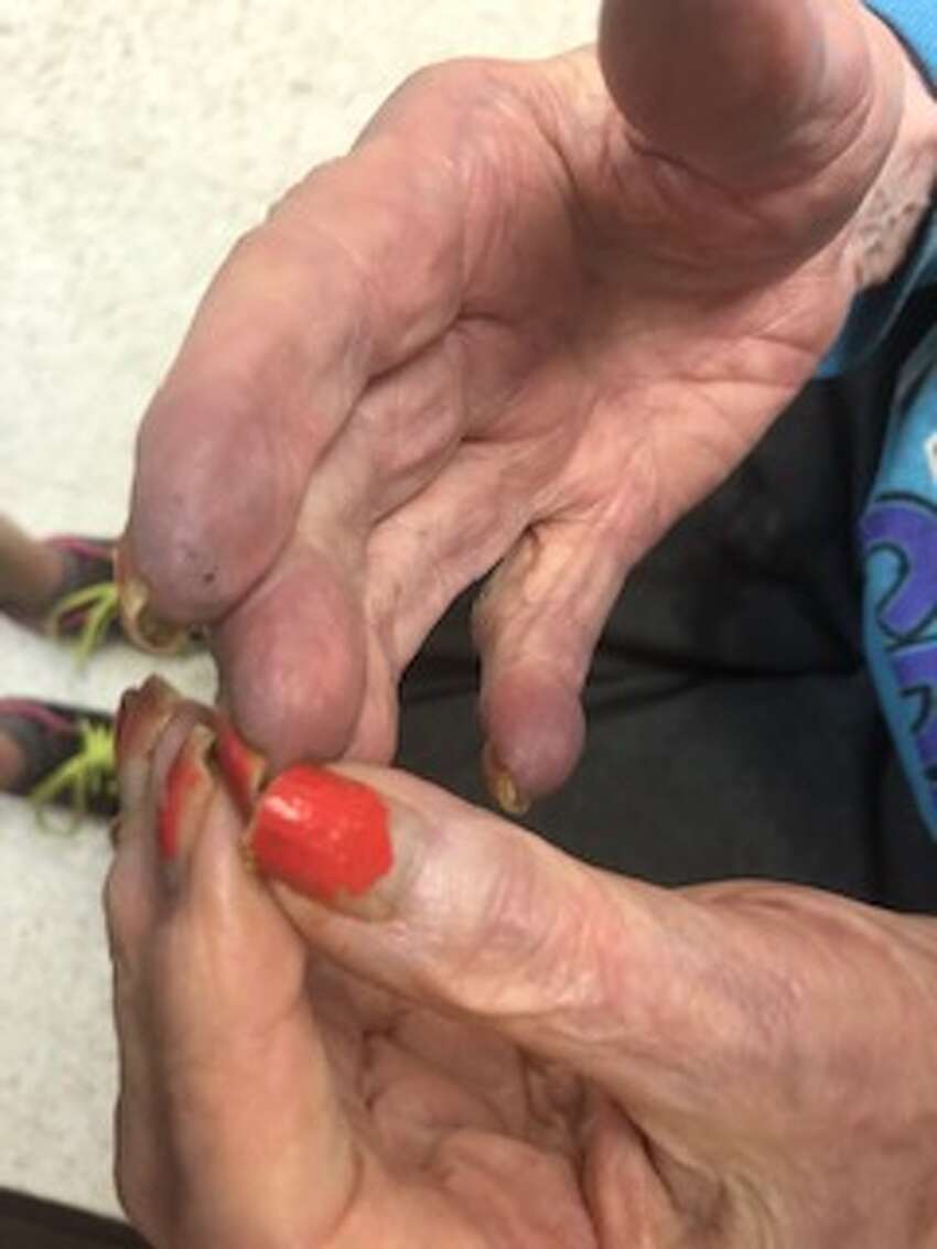 Mary Beth Delarm began documenting visits to her mother at the Diamond Hill nursing home in Schaghticoke last year. She believes her mother, who is in her 90s and has dementia, was being neglected based on the conditions she often found her in. In this photo her fingers are dirty and turning purple.
