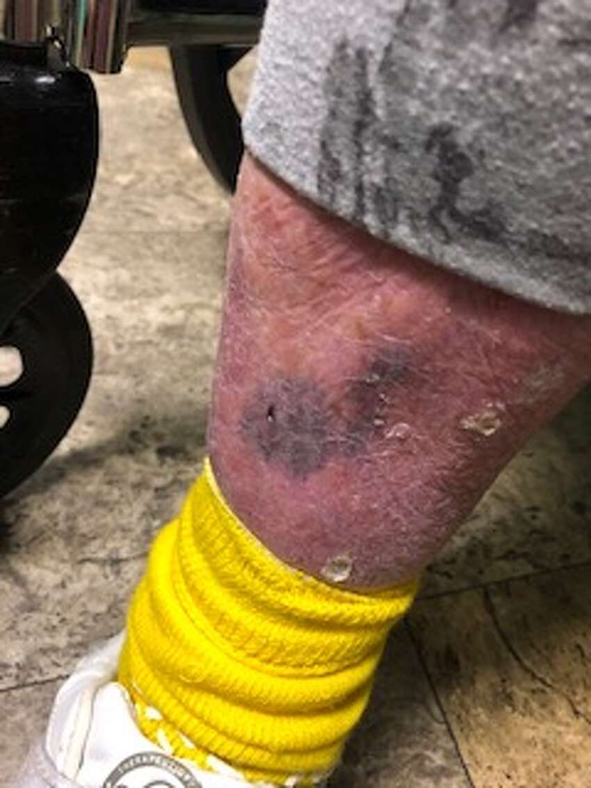 Mary Beth Delarm began documenting visits to her mother at the Diamond Hill nursing home in Schaghticoke last year. She believes her mother, who is in her 90s and has dementia, was being neglected based on the conditions she often found her in. In this photo her legs are 