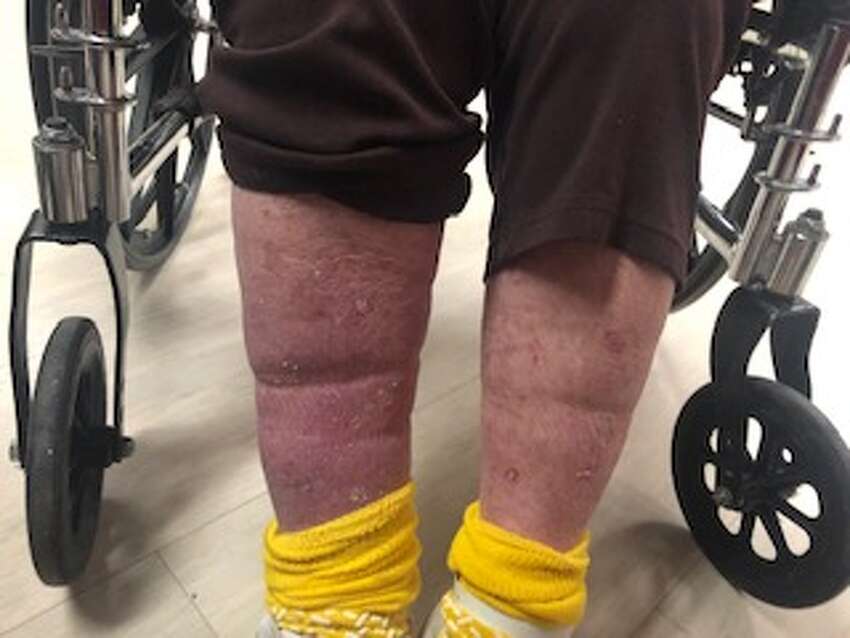 Mary Beth Delarm began documenting visits to her mother at the Diamond Hill nursing home in Schaghticoke last year. She believes her mother, who is in her 90s and has dementia, was being neglected based on the conditions she often found her in. In this photo, an indentation is seen where too-tight socks had cut off her mother's circulation.