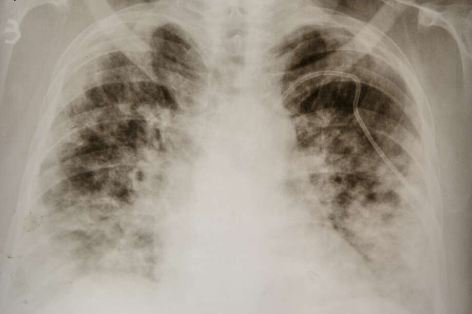 A chest X-ray of a COVID-19 patient shows "consolidation," a radiological term refering to dense opacities obscuring lung vessels and bronchial walls. (File photo from the Zakarpattia Centre of Lung Diseases, Uzhhorod, western Ukraine, Photo: SerhiiHudak/Barcroft Media Via Getty Images / ©Ukrinform
