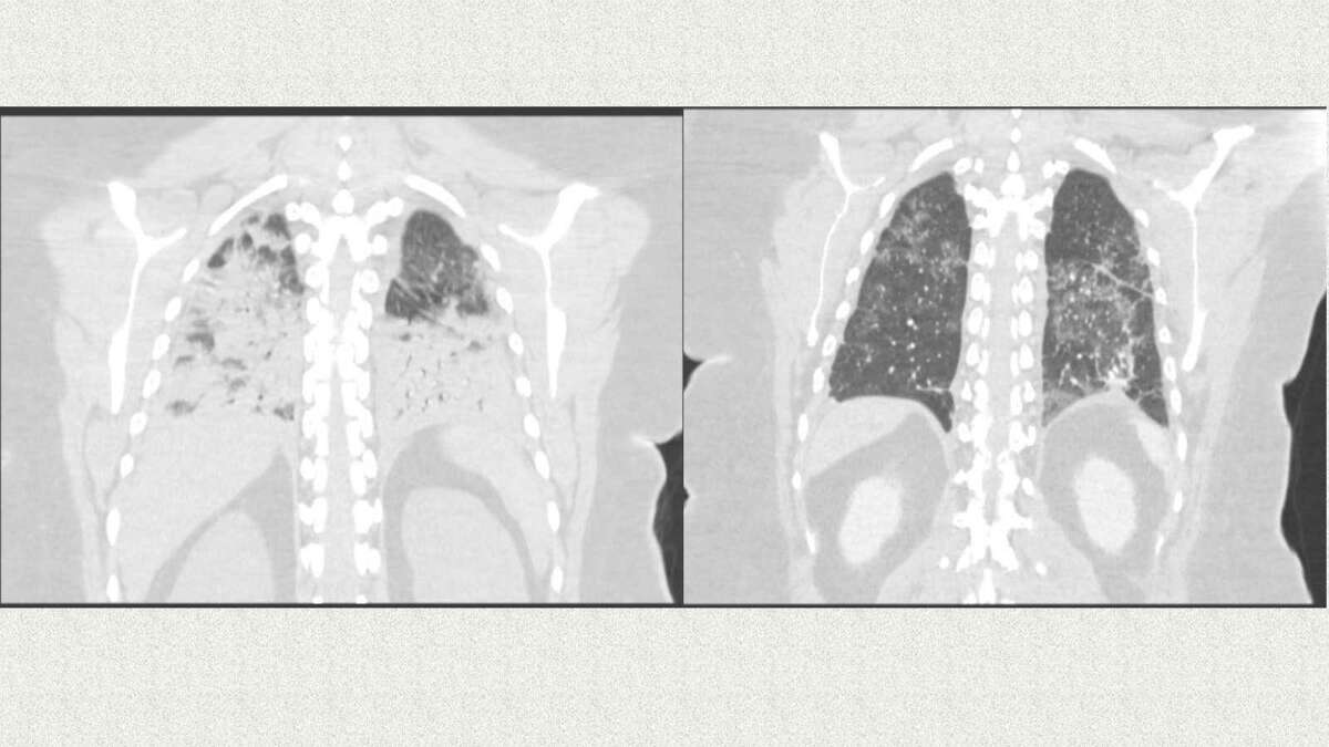 Left photo is an X-ray of Andrea Seboyon’s lungs at admission to UMMC. The lighter areas are infected with COVID- 19 and darker areas are remaining healthy lung. The right photo is an X-ray after treatment.
