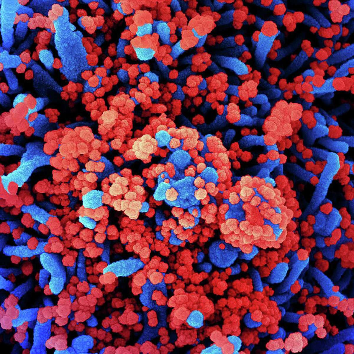 This undated handout image obtained July 28, 2020, courtesy of National Institute of Allergy and Infectious Diseases(NIH/NIAID), shows a colorized scanning electron micrograph of a cell (blue) heavily infected with SARS-CoV-2 virus particles (red), isolated from a patient sample. (Photo by - / National Institute of Allergy and Infectious Diseases / AFP) / RESTRICTED TO EDITORIAL USE - MANDATORY CREDIT "AFP PHOTO /NATIONAL INSTITUTE OF ALLERGY AND INFECTIOUS DISEASES/HANDOUT " - NO MARKETING - NO ADVERTISING CAMPAIGNS - DISTRIBUTED AS A SERVICE TO CLIENTS (Photo by -/National Institute of Allergy an/AFP via Getty Images)