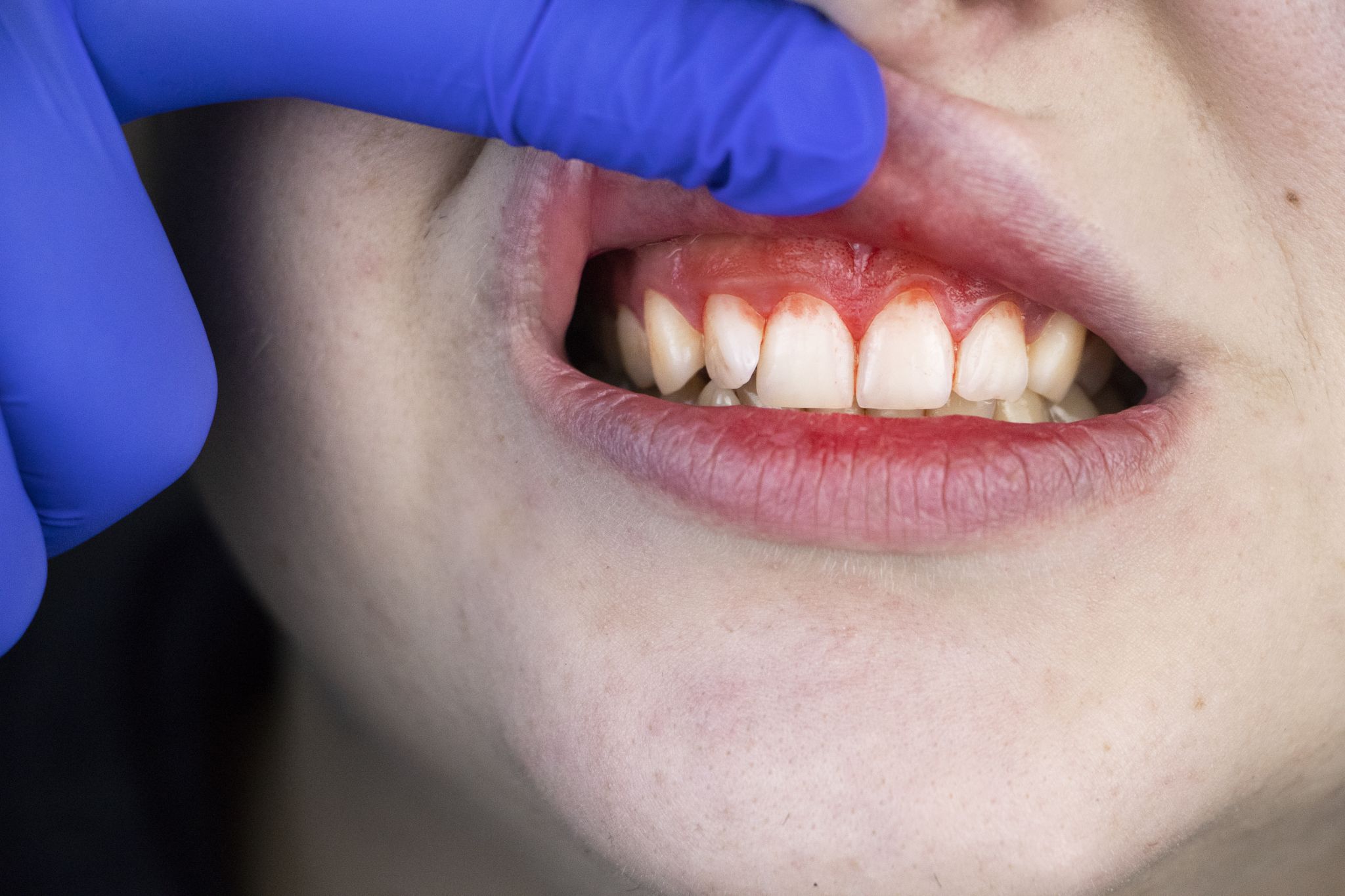 Bleeding, swollen gums linked to severe COVID19 cases