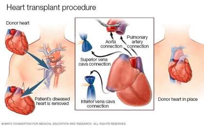 A diagram shows the way a heart transplant is done.
