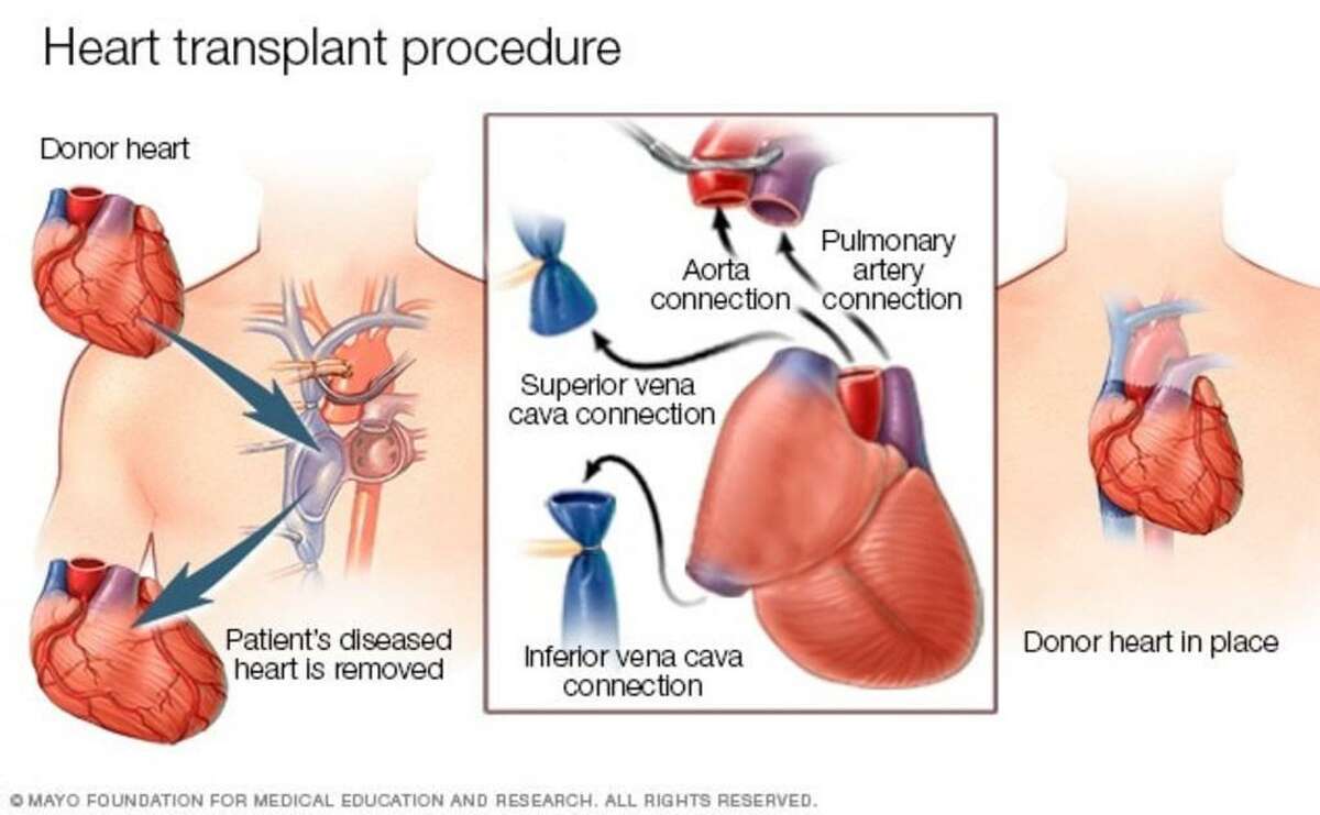 Yale docs 'doing it for the heart': Technology brings more transplants with shorter wait Yale docs 'doing it for the heart': Technology brings more transplants with shorter wait