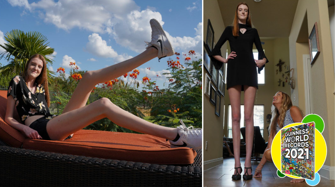 Embrace' differences: Teen secures record for world's longest female legs, US News