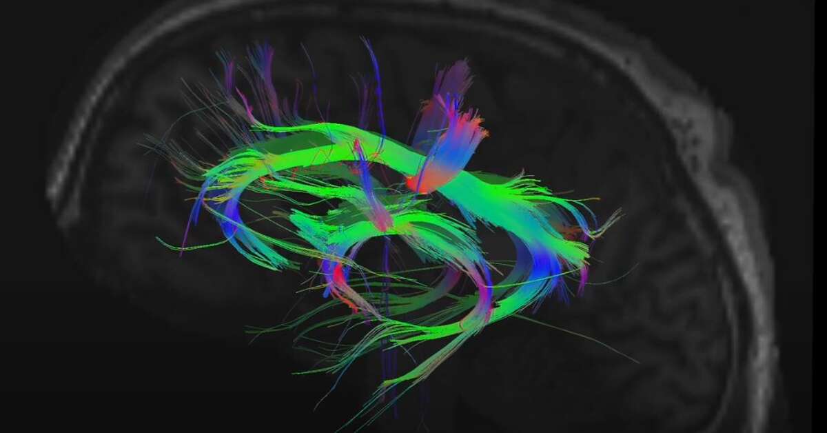 High resolution imaging with GE’s experimental advanced brain microstructure MRI scanner