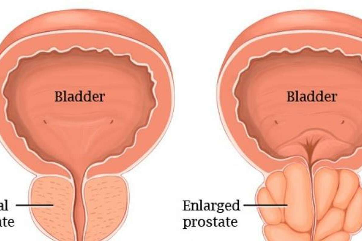 Pre Screening Key To Combating Prostate Cancer