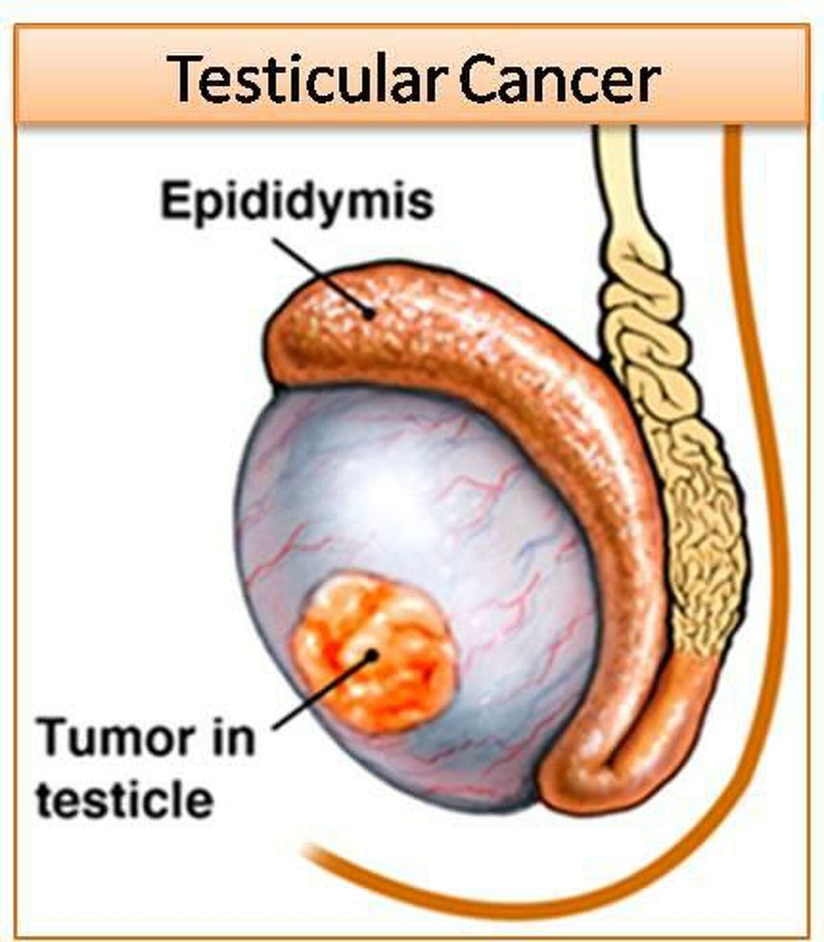 Urologists Advocate Screening For Testicular Cancer Bph
