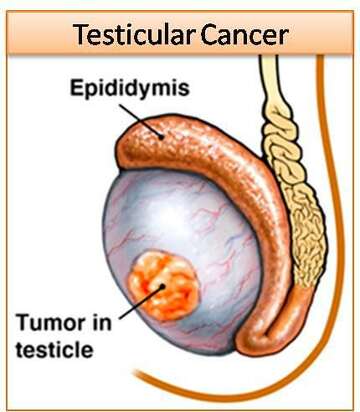 Urologists advocate screening for testicular cancer, BPH ...